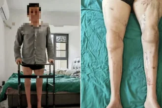 A factory worker whose legs were severed in a horror machinery accident has learned to walk again after doctors spent almost eight hours reattaching them.