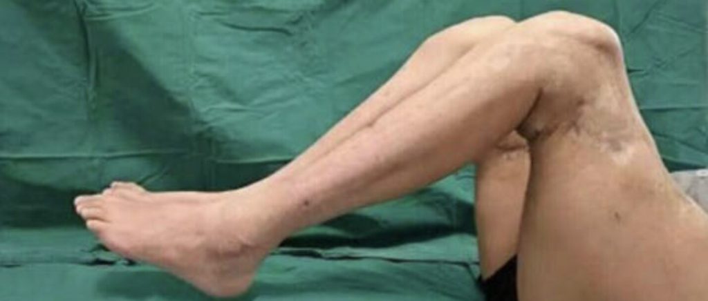 A factory worker whose legs were severed in a horror machinery accident has learned to walk again after doctors spent almost eight hours reattaching them.