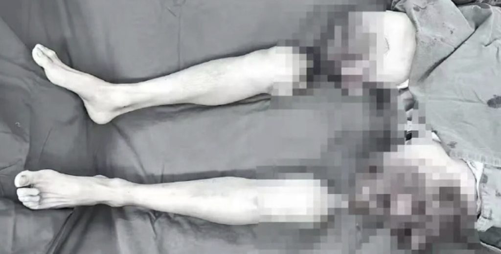 A factory worker whose legs were severed in a horror machinery accident has learned to walk again after doctors spent almost eight hours reattaching them.
