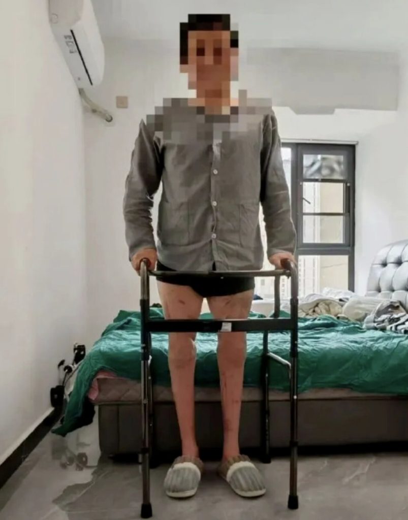 A factory worker whose legs were severed in a horror machinery accident has learned to walk again after doctors spent almost eight hours reattaching them.