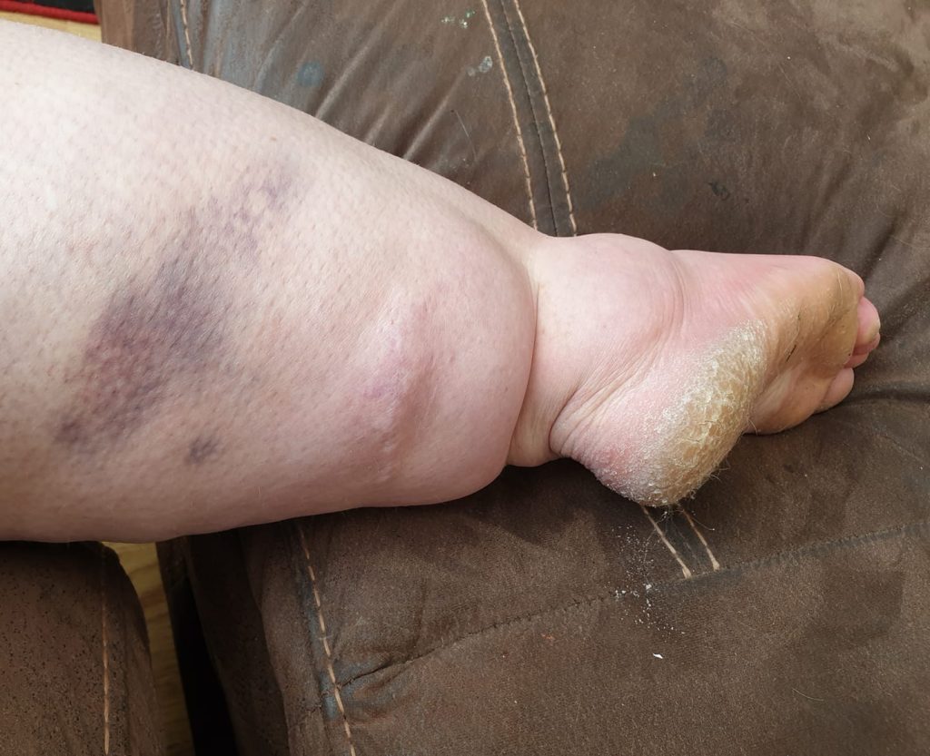 Mum who hit 30st and watched her legs balloon while eating salads was told to diet for years by doctors who missed the real cause - a chronic illness called lymphoedema.