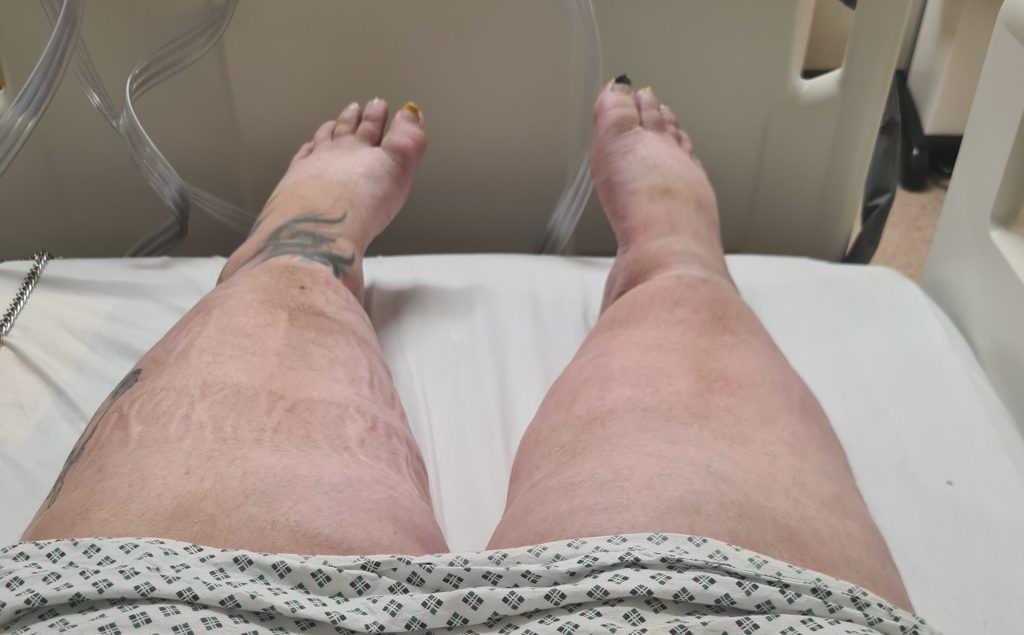 Mum who hit 30st and watched her legs balloon while eating salads was told to diet for years by doctors who missed the real cause - a chronic illness called lymphoedema.