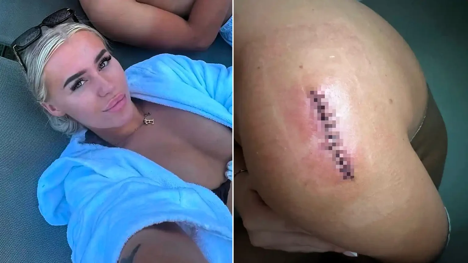 'Sunbed addict' diagnosed with melanoma at 22 after ignoring doctors who told her not to remove a mole - she now warns tanning beds should be banned.
