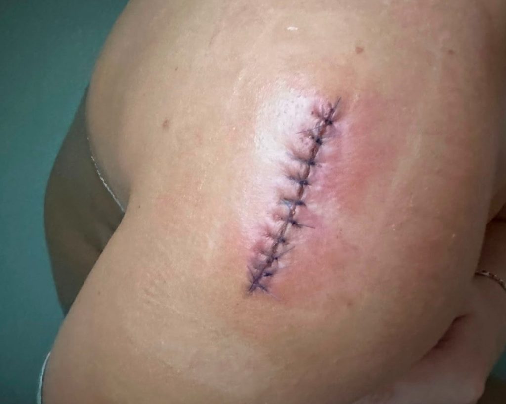 'Sunbed addict' diagnosed with melanoma at 22 after ignoring doctors who told her not to remove a mole - she now warns tanning beds should be banned.