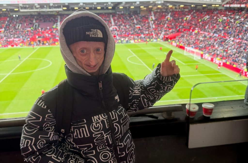 Influencer Michiel Vandeweert, who had rare 'Benjamin Button' disease, has died aged 28, defying doctors who predicted he would not live beyond his 12th birthday.