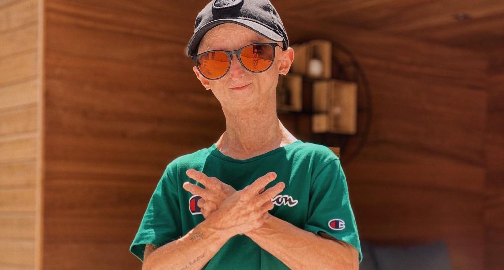 Influencer Michiel Vandeweert, who had rare 'Benjamin Button' disease, has died aged 28, defying doctors who predicted he would not live beyond his 12th birthday.