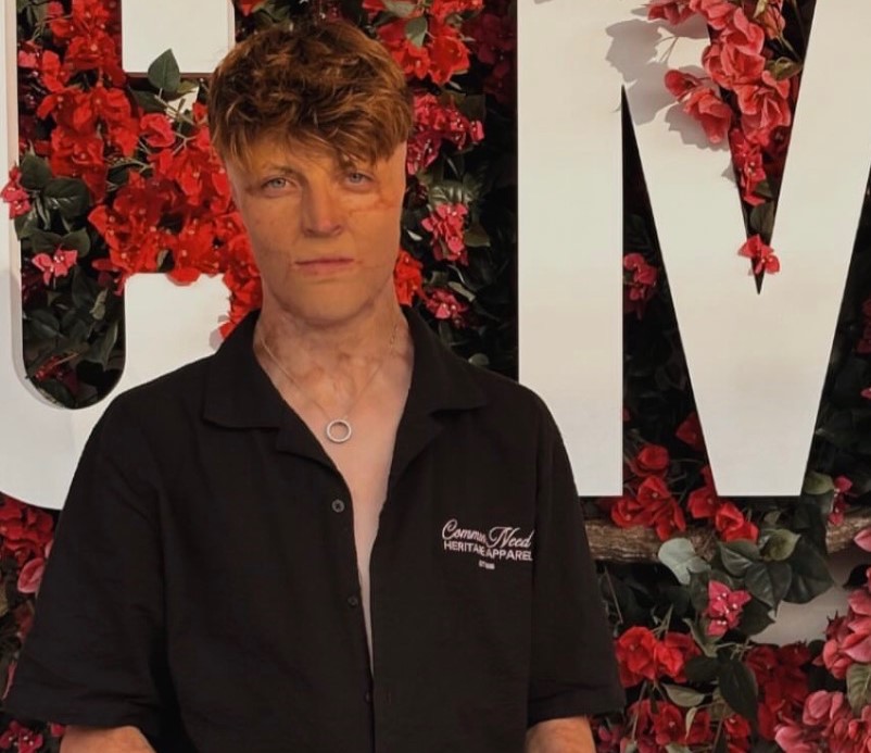Teenager left with burns across 38% of his body after his father set off gas cylinders in the family car is now chasing his acting dream on red carpets alongside Hollywood stars.