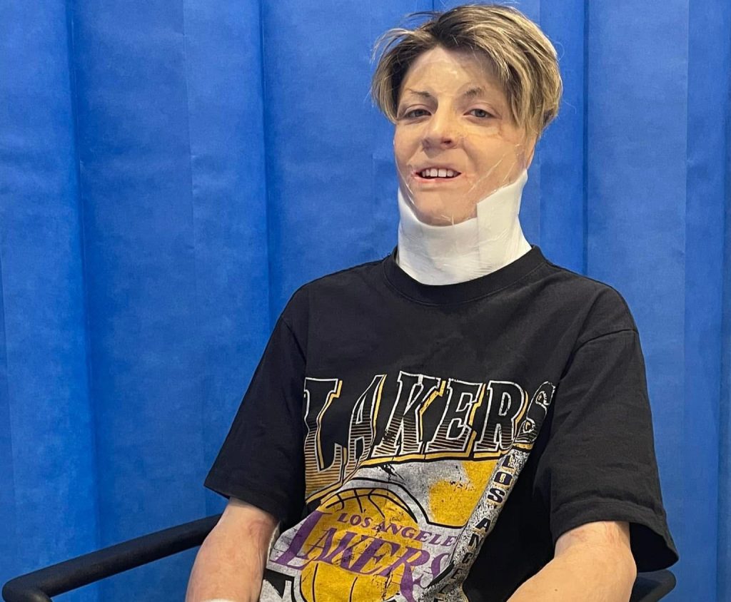 Teenager left with burns across 38% of his body after his father set off gas cylinders in the family car is now chasing his acting dream on red carpets alongside Hollywood stars.