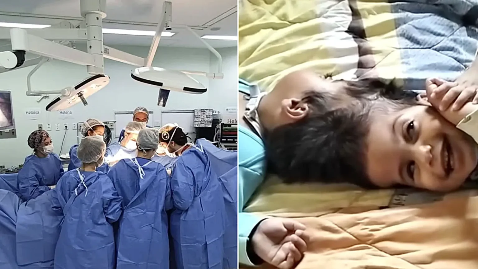 Conjoined twins joined at the head have died after the final stage of a complex 15-hour separation surgery - having been successfully separated hours earlier.