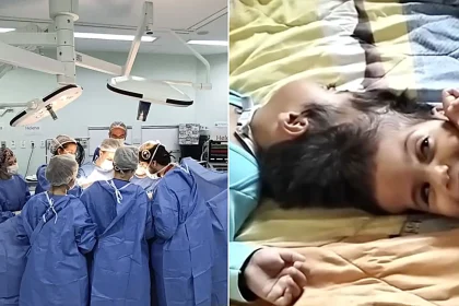 Conjoined twins joined at the head have died after the final stage of a complex 15-hour separation surgery - having been successfully separated hours earlier.