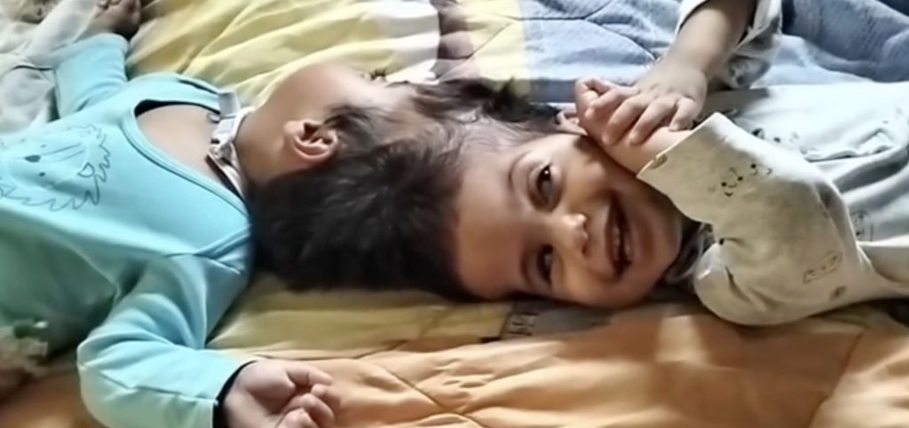 Conjoined twins joined at the head have died after the final stage of a complex 15-hour separation surgery - having been successfully separated hours earlier.