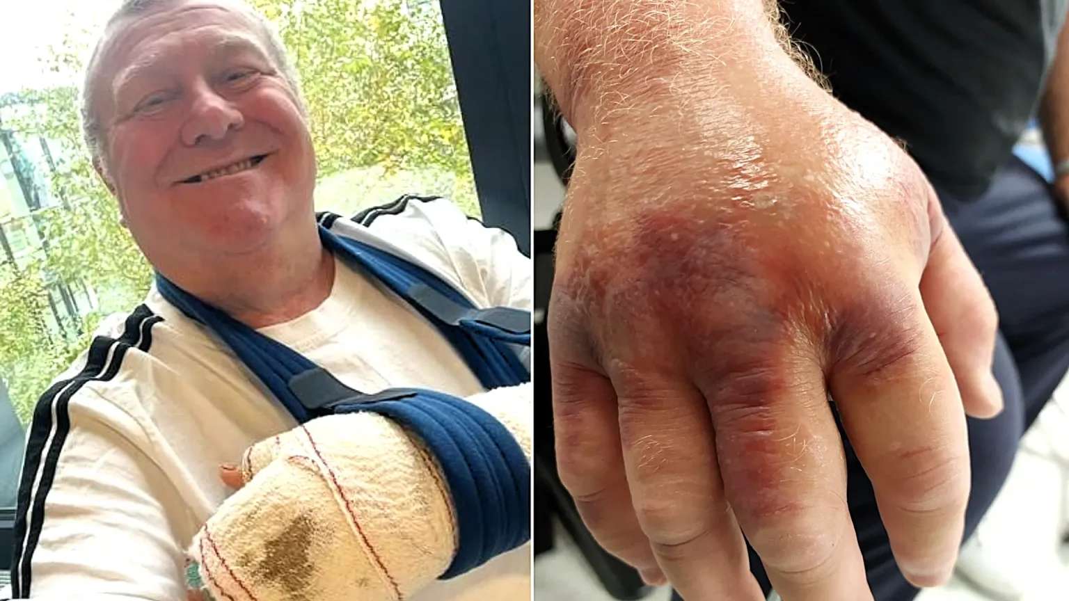 Man left in a coma for four days after a spider bite gave him a flesh-eating bug says the near-death ordeal helped him turn his life around - going on to shed almost seven stone.