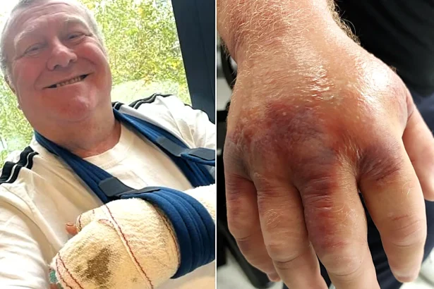 Man left in a coma for four days after a spider bite gave him a flesh-eating bug says the near-death ordeal helped him turn his life around - going on to shed almost seven stone.
