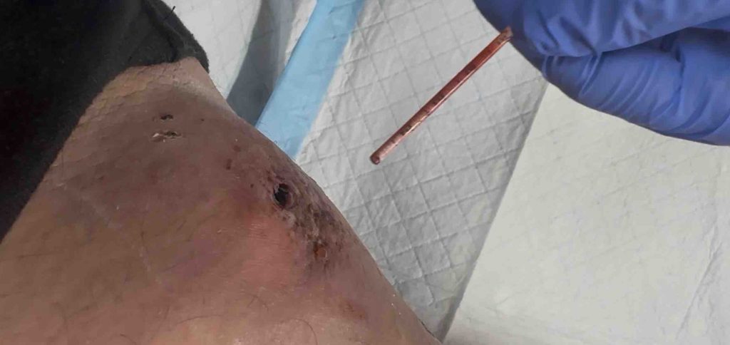 A man mauled by an 80lb dog while taking out his bins in his pyjamas has been left with a three-inch-deep cavity beneath the skin of his leg.