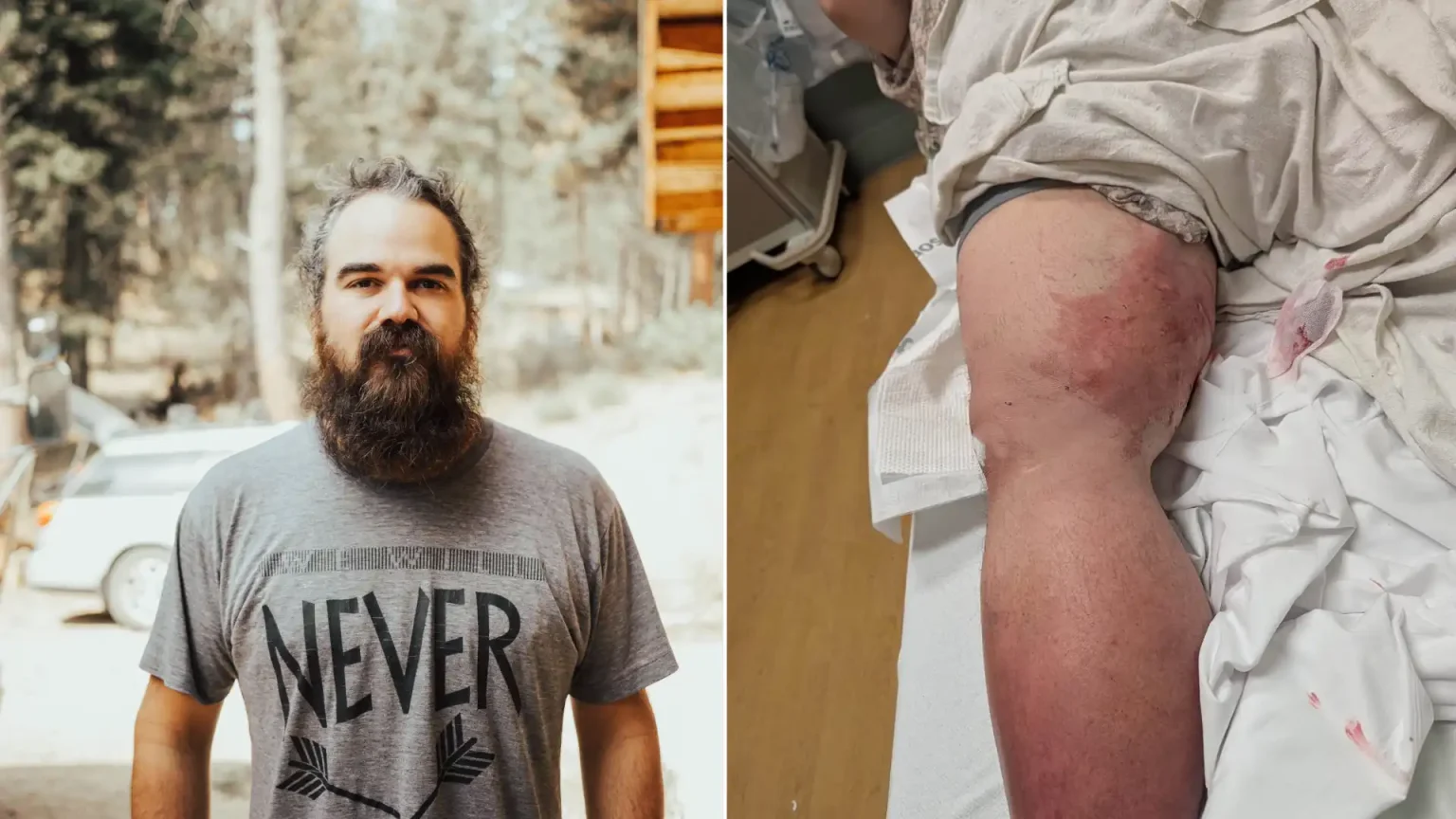 A man mauled by an 80lb dog while taking out his bins in his pyjamas has been left with a three-inch-deep cavity beneath the skin of his leg.