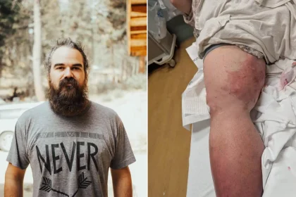 A man mauled by an 80lb dog while taking out his bins in his pyjamas has been left with a three-inch-deep cavity beneath the skin of his leg.