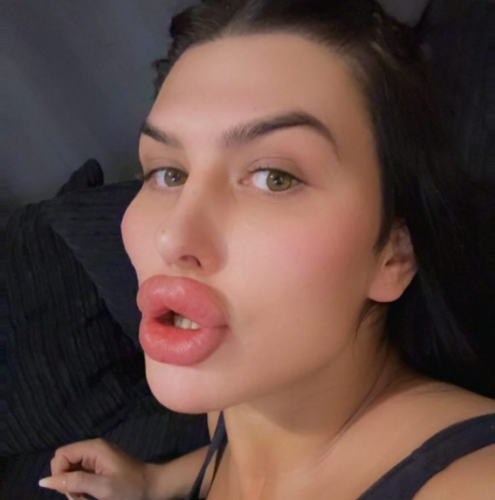 Woman with Britain's biggest lips reveals how she injected filler at home after clinics refused her - completing just a six-week online course before doing the risky job herself.
