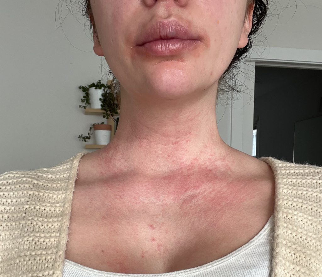 Mum whose skin was so inflamed doctors said she looked like a burns survivor was convinced she had a food allergy - but the real trigger was crippling stress.