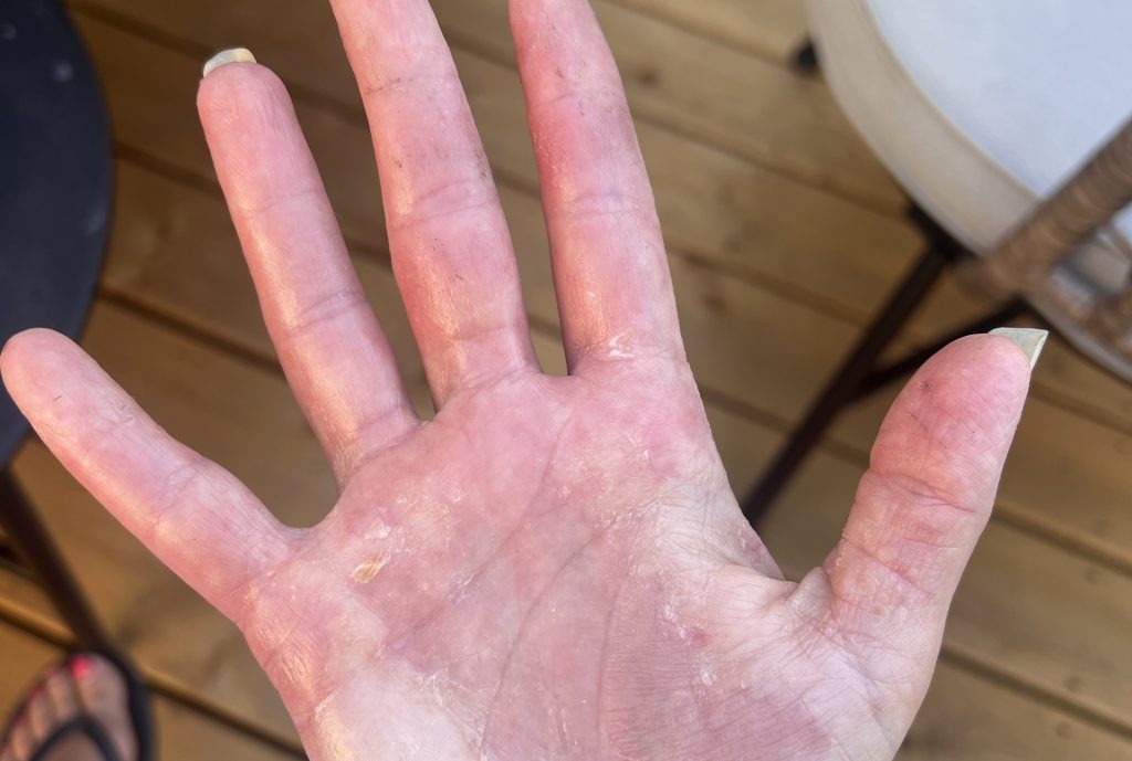 Mum whose skin was so inflamed doctors said she looked like a burns survivor was convinced she had a food allergy - but the real trigger was crippling stress.