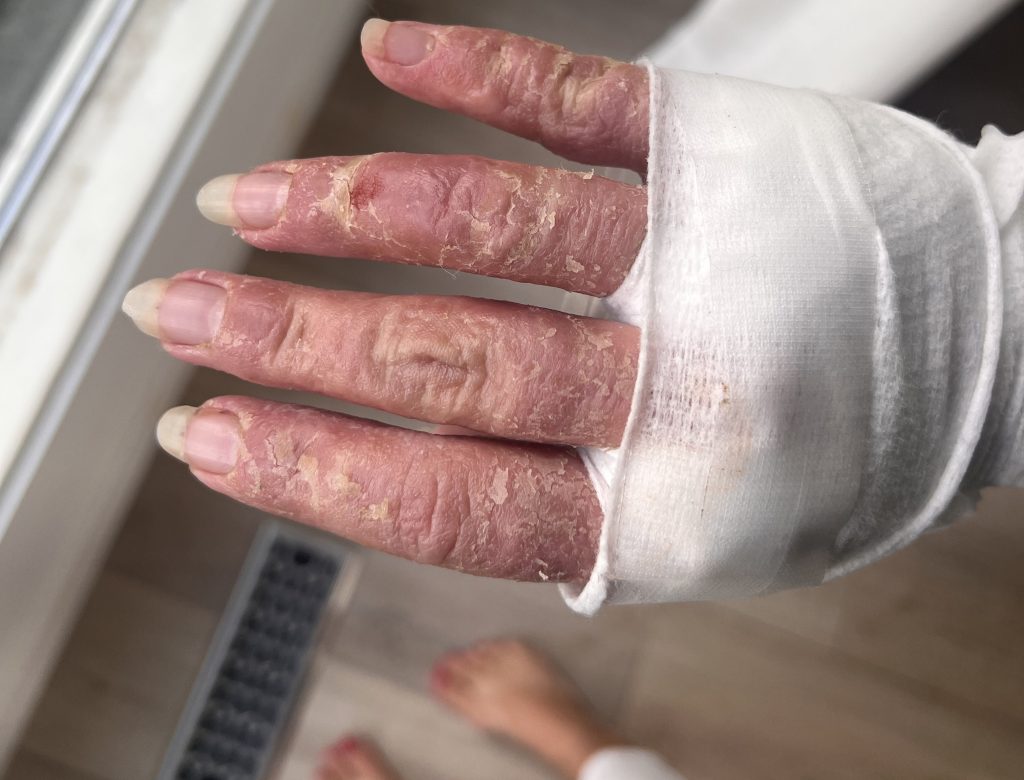 Mum whose skin was so inflamed doctors said she looked like a burns survivor was convinced she had a food allergy - but the real trigger was crippling stress.