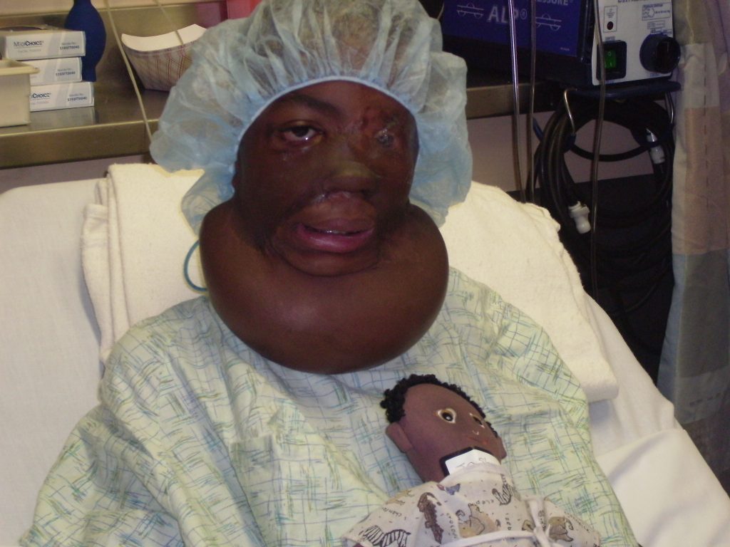 Man who grew up sleeping beside his dogs reveals the horror moment two pitbulls mauled his face - leaving him without his nose and ears after a 26-hour surgery.