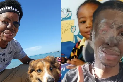 Man who grew up sleeping beside his dogs reveals the horror moment two pitbulls mauled his face - leaving him without his nose and ears after a 26-hour surgery.