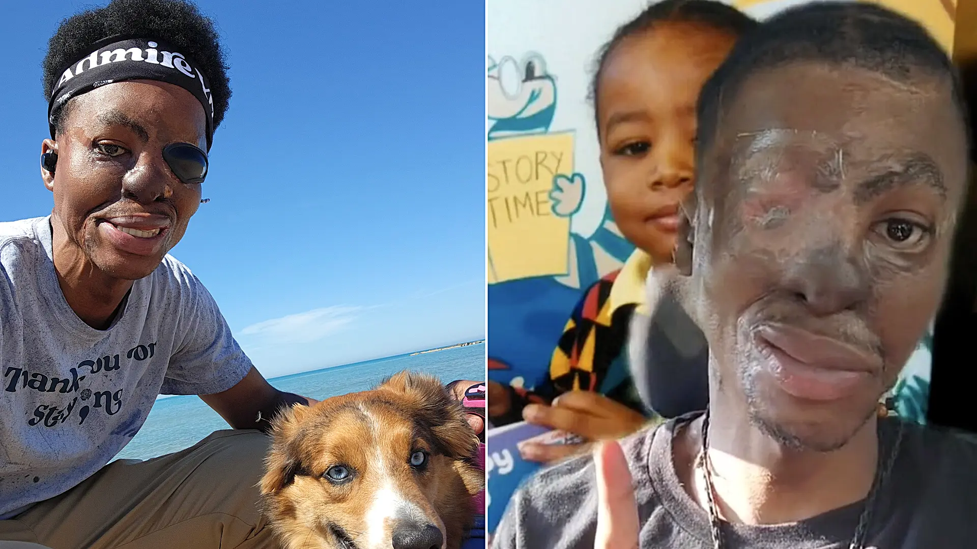 Man who grew up sleeping beside his dogs reveals the horror moment two pitbulls mauled his face - leaving him without his nose and ears after a 26-hour surgery.