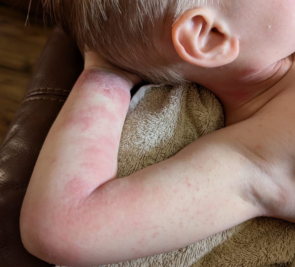 Heartbroken mum reveals her three-year-old son kept waking up covered in blood from bone-deep eczema itch - until specialist pyjamas with built-in mittens changed everything.