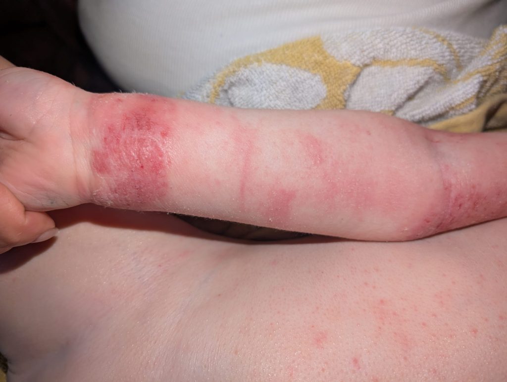 Heartbroken mum reveals her three-year-old son kept waking up covered in blood from bone-deep eczema itch - until specialist pyjamas with built-in mittens changed everything.