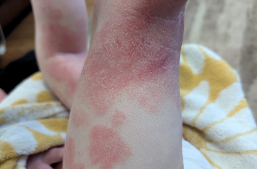 Heartbroken mum reveals her three-year-old son kept waking up covered in blood from bone-deep eczema itch - until specialist pyjamas with built-in mittens changed everything.