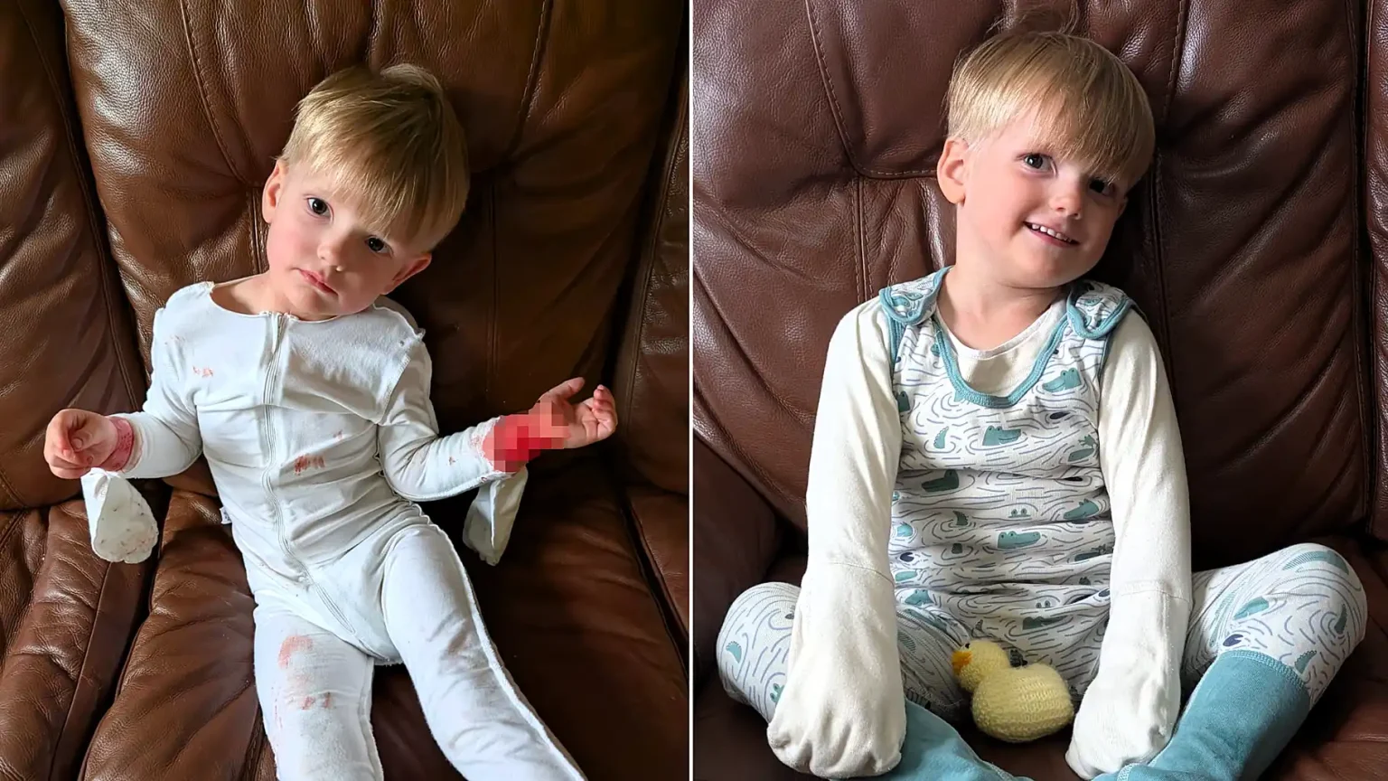 Heartbroken mum reveals her three-year-old son kept waking up covered in blood from bone-deep eczema itch - until specialist pyjamas with built-in mittens changed everything.