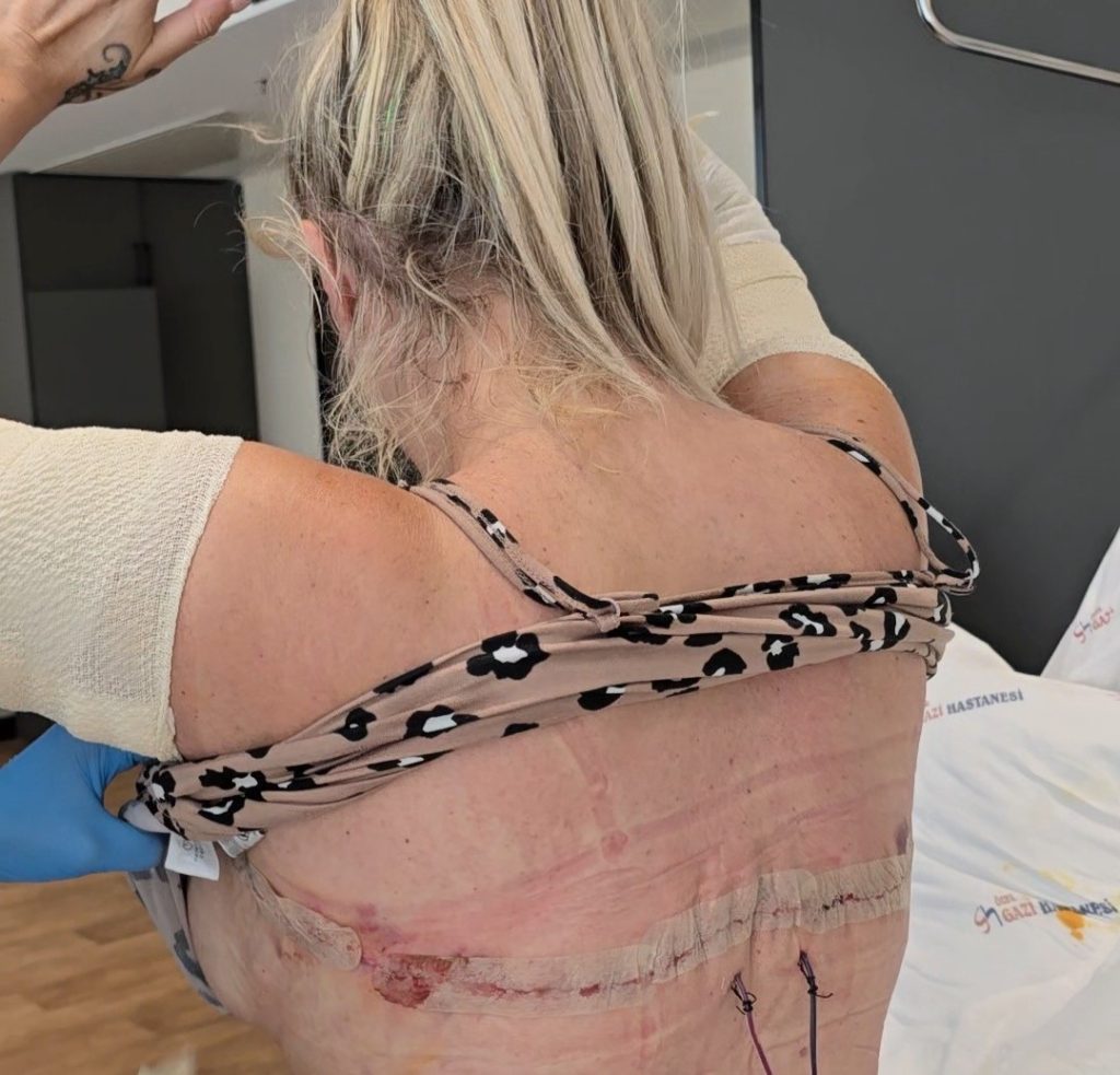Recovered ketamine addict who spent thousands on a full-body mummy makeover says she now loves herself - despite scarring that leaves her feeling like Frankenstein's bride.
