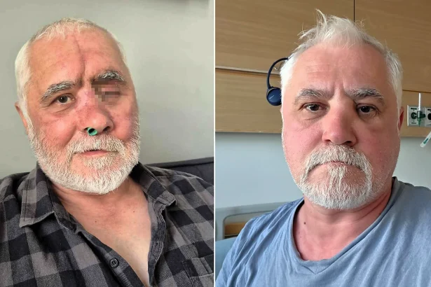 A man whose watering eye turned out to be an aggressive cancer that invaded his entire skull needed his whole face rebuilt by surgeons in order to save his life.