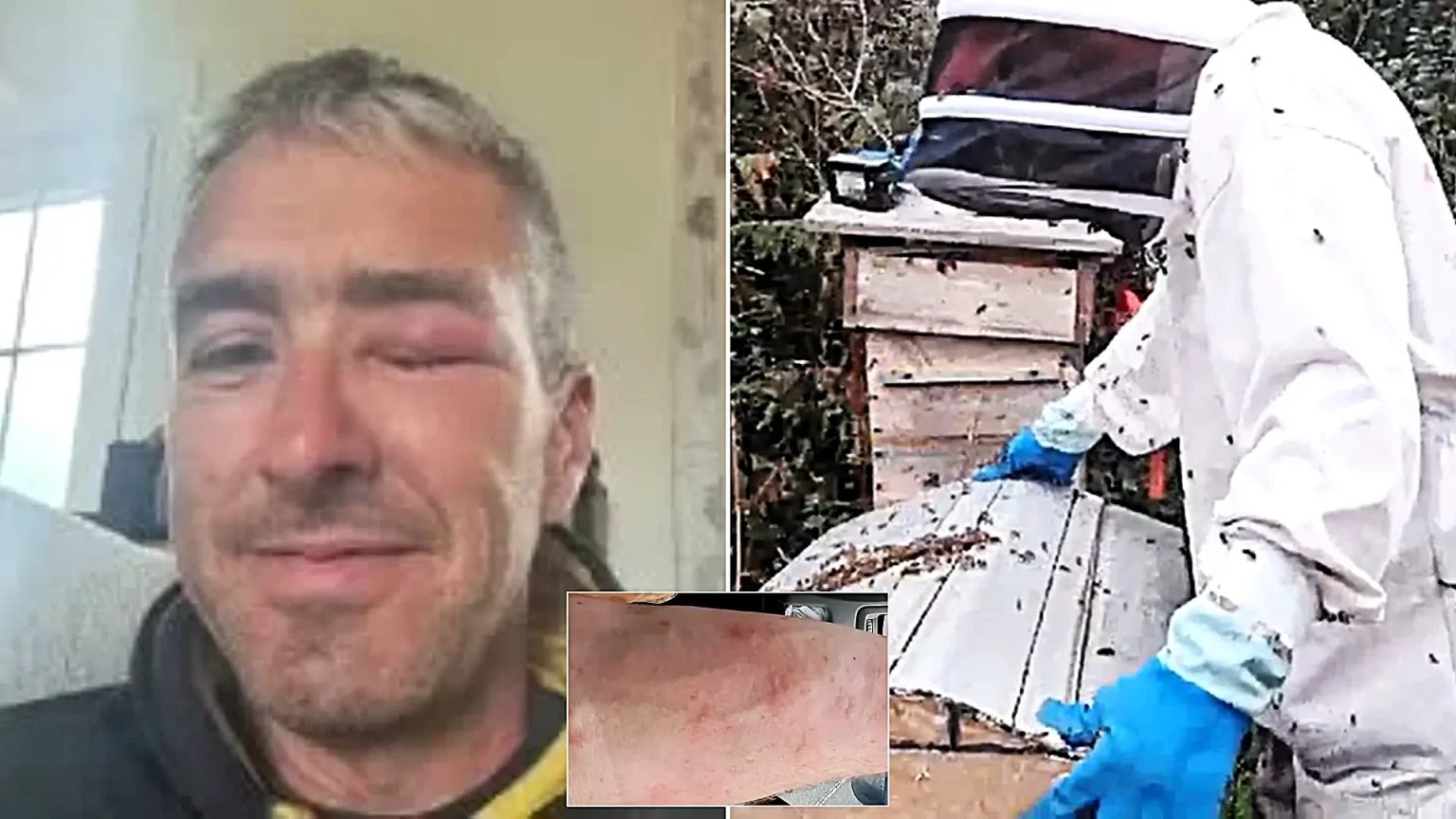 A carpenter looked like he had been beaten up with swellings all over his body after an angry bee swarm viciously attacked him - stinging him over 60 times.