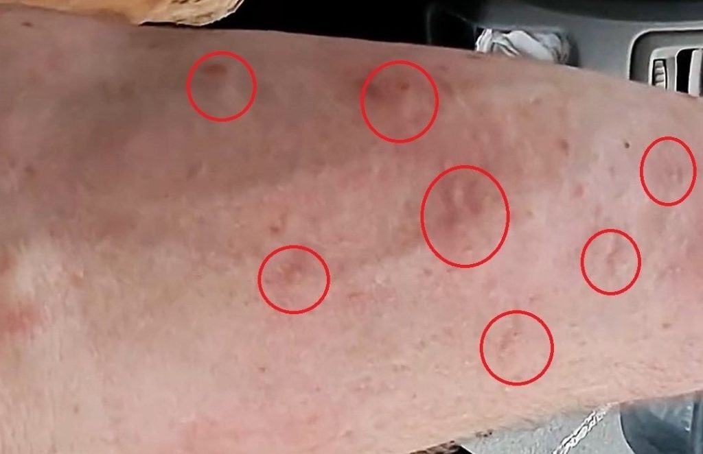 A carpenter looked like he had been beaten up with swellings all over his body after an angry bee swarm viciously attacked him - stinging him over 60 times.