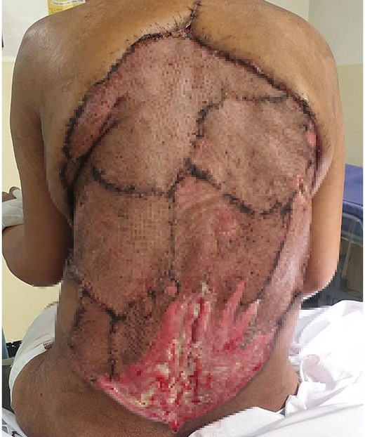 Woman had a 40cm chunk of her back cut away when a flesh-eating infection left her ribs and spine exposed - after five years of untreated diabetes.