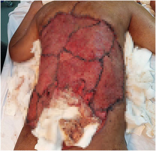 Woman had a 40cm chunk of her back cut away when a flesh-eating infection left her ribs and spine exposed - after five years of untreated diabetes.