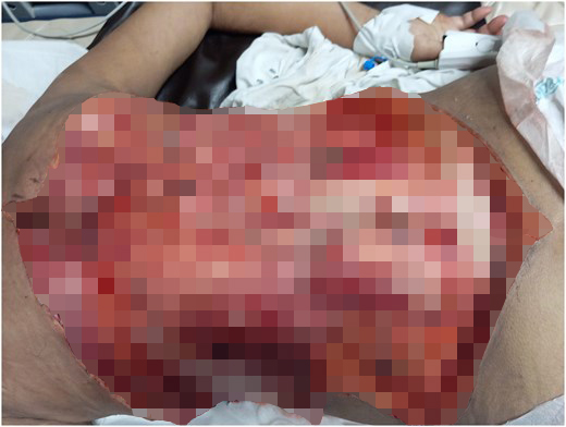 Woman had a 40cm chunk of her back cut away when a flesh-eating infection left her ribs and spine exposed - after five years of untreated diabetes.