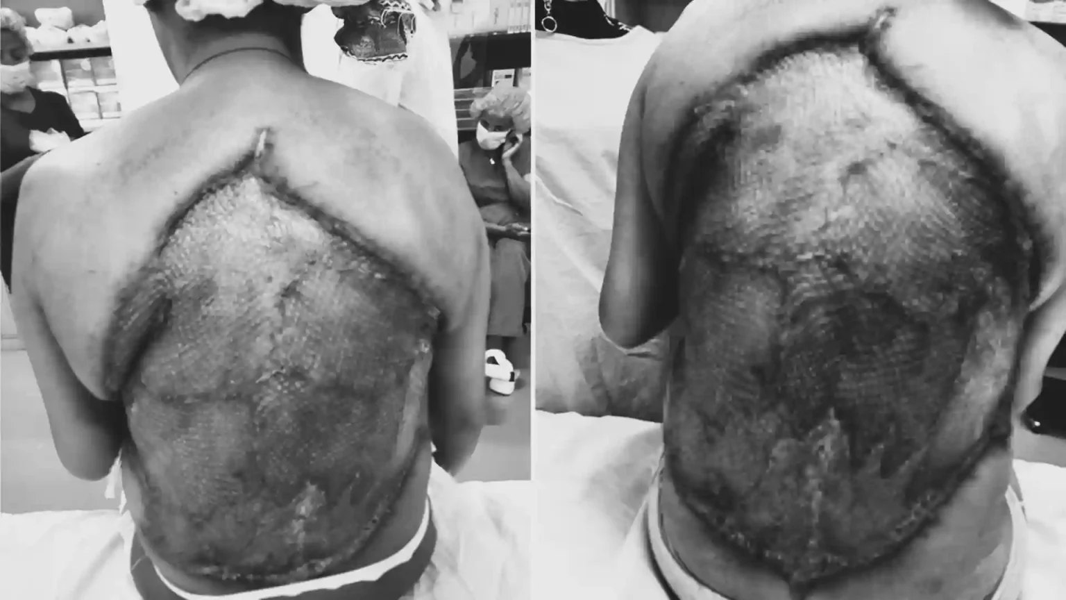 Woman had a 40cm chunk of her back cut away when a flesh-eating infection left her ribs and spine exposed - after five years of untreated diabetes.