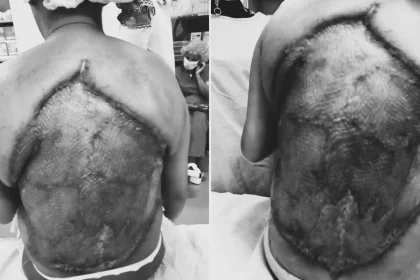 Woman had a 40cm chunk of her back cut away when a flesh-eating infection left her ribs and spine exposed - after five years of untreated diabetes.