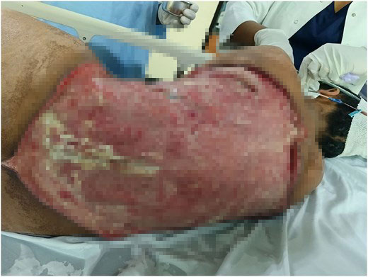 Woman had a 40cm chunk of her back cut away when a flesh-eating infection left her ribs and spine exposed - after five years of untreated diabetes.
