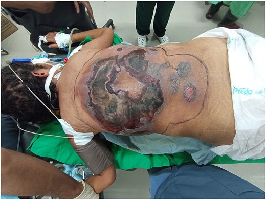 Woman had a 40cm chunk of her back cut away when a flesh-eating infection left her ribs and spine exposed - after five years of untreated diabetes.