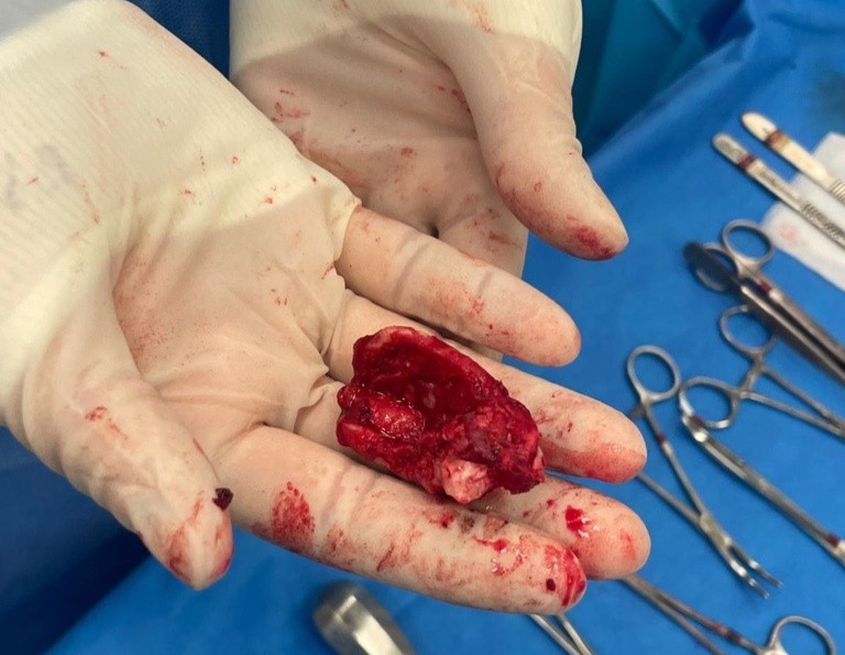 A rescue pony's suspected abscess turned out to be two giant teeth growing inside his skull - vets called the rare ear tooth case one of their most bizarre ever.