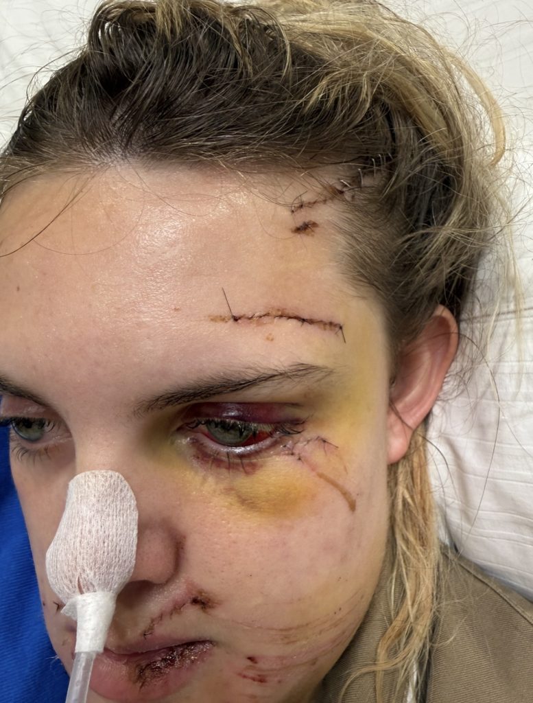 Tia Lockey's dream Asia trip was ruined at the start when a motorbike crash in Thailand shattered her jaw in two places - leaving her with no feeling in her face.