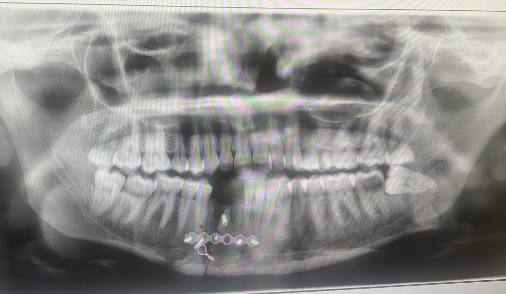 Tia Lockey's dream Asia trip was ruined at the start when a motorbike crash in Thailand shattered her jaw in two places - leaving her with no feeling in her face.