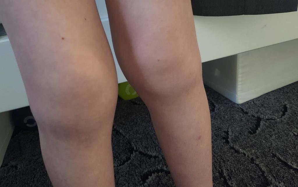 A mum was heartbroken when her baby began army crawling across the floor - it was the same warning sign that led to her own painful arthritis diagnosis.