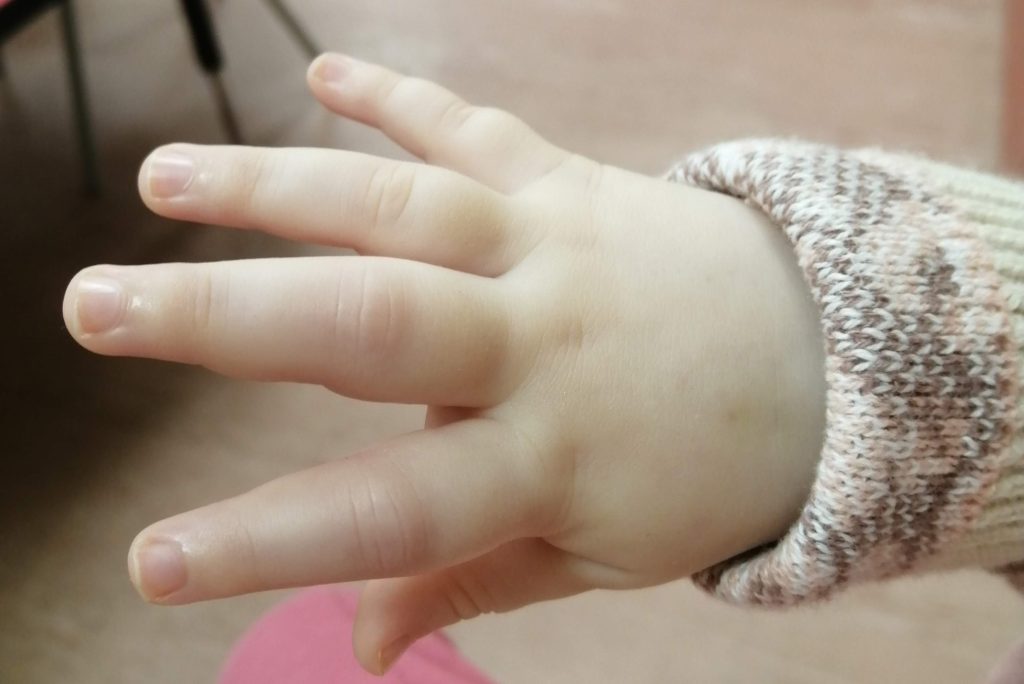 A mum was heartbroken when her baby began army crawling across the floor - it was the same warning sign that led to her own painful arthritis diagnosis.