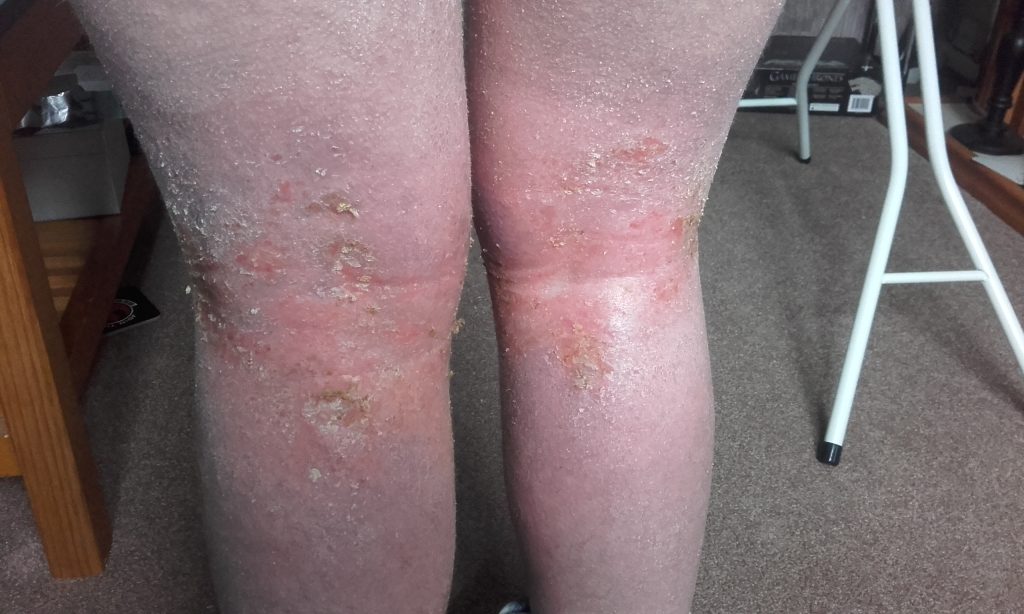 A woman who quit her eczema steroid creams says she felt boiled alive - her skin turned beetroot red, oozed and left her housebound and screaming for months.