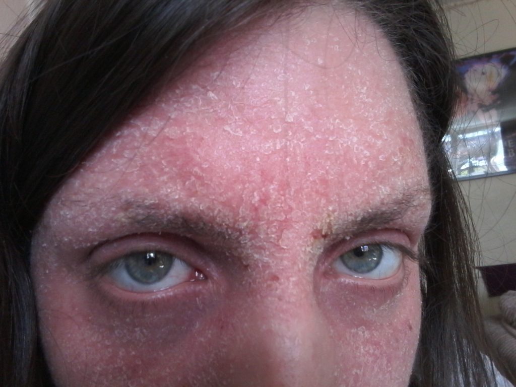 A woman who quit her eczema steroid creams says she felt boiled alive - her skin turned beetroot red, oozed and left her housebound and screaming for months.