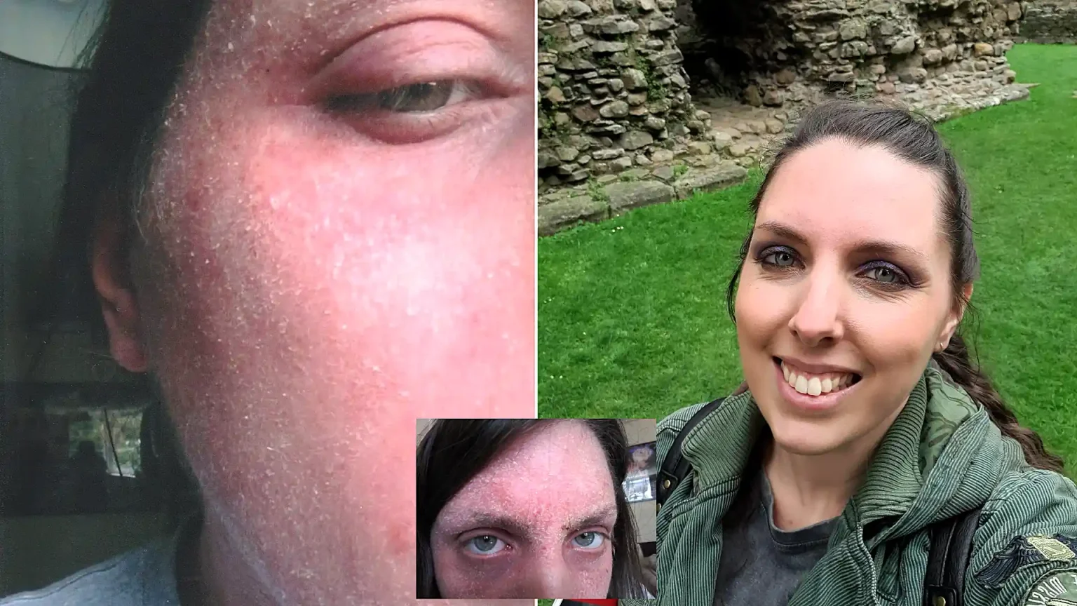 A woman who quit her eczema steroid creams says she felt boiled alive - her skin turned beetroot red, oozed and left her housebound and screaming for months.